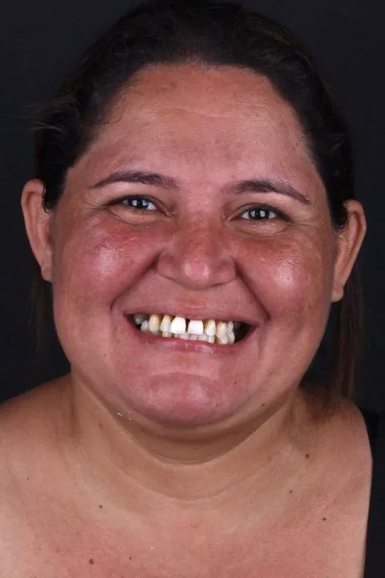 Antes