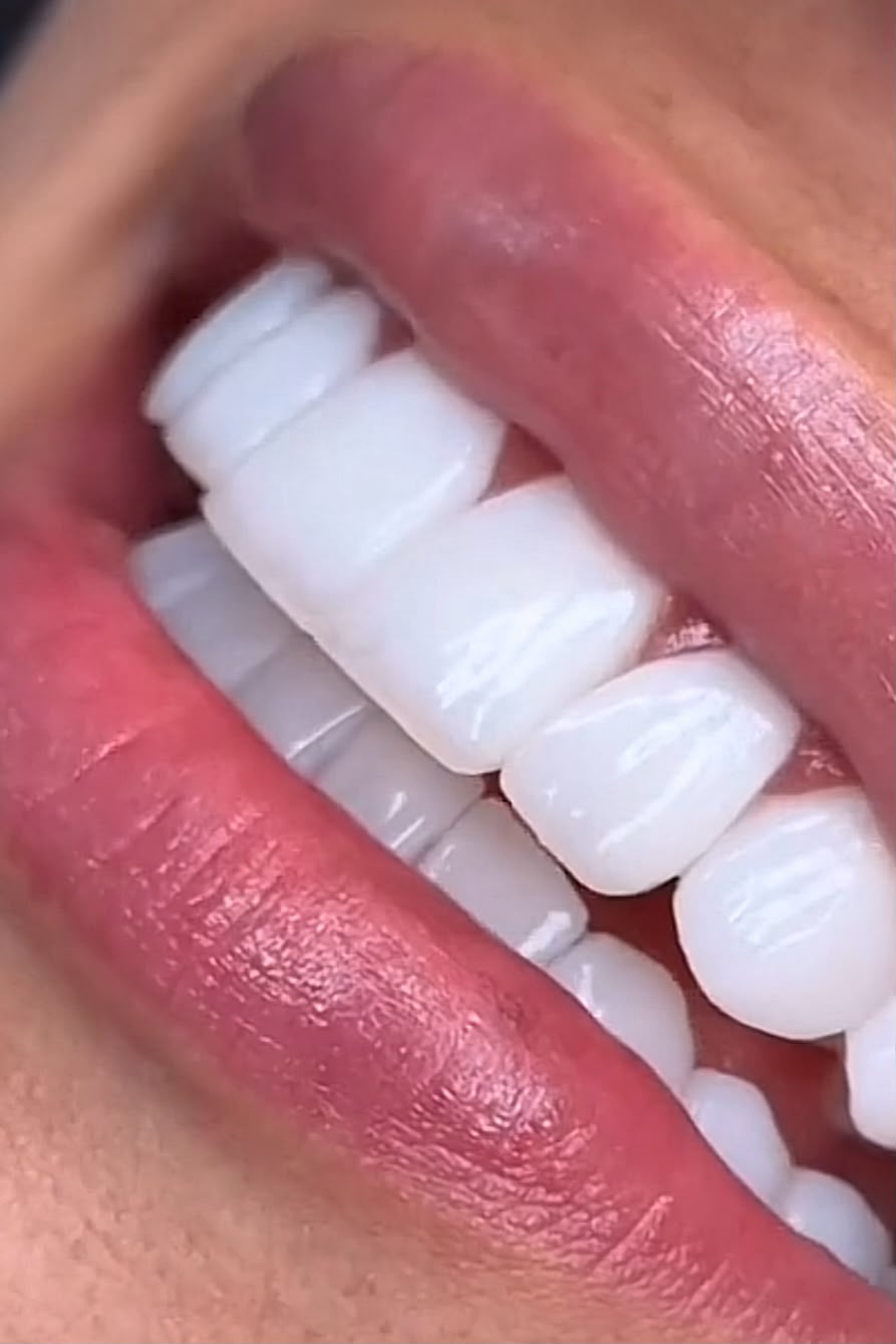 Clareamento Dental — Oral Sin Camboriú