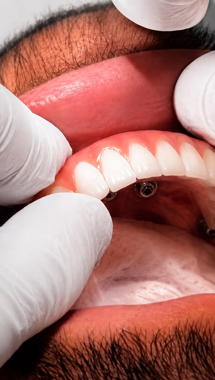 Implantes Dentários