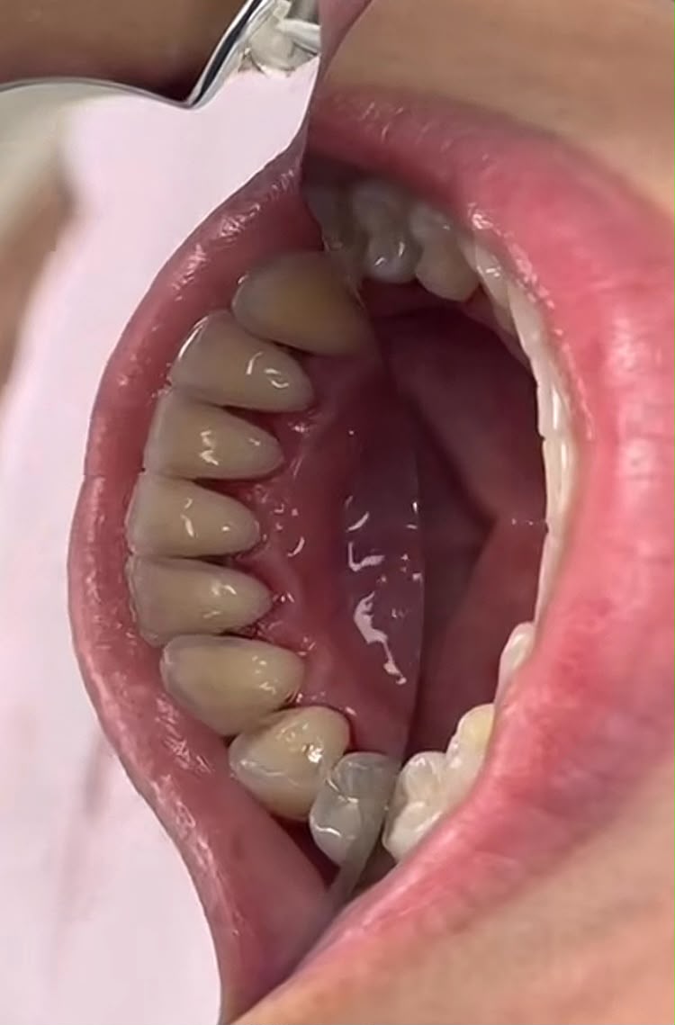 Limpeza Dental — Oral Sin Camboriú